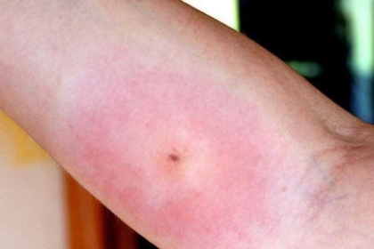 متى تصبح لدغة العنكبوت خطيرة؟