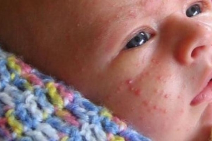 أسباب ظهور حبوب حمراء في وجه الرضيع