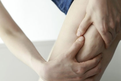 السيلوليت قد يحمي النساء من الخرف والسكتات الدماغية!