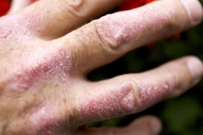 أسباب تقشر الجلد.. تعرف عليها