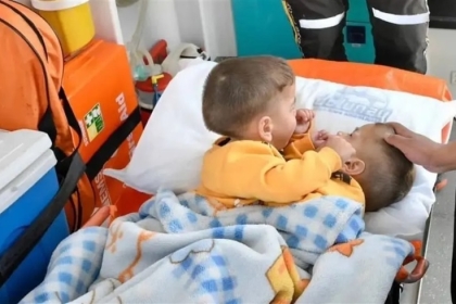 تمر بـ 5 مراحل.. عملية لفصل "التوأم السيامي" السوري إحسان وبسام