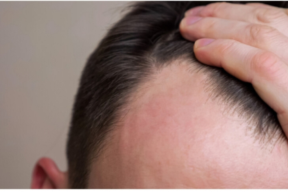 أدوية إنقاص الوزن قد ترتبط بتساقط الشعر لدى الرجال