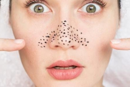 أسباب ظهور الرؤوس السوداء في وجه الشباب.. وطرق التخلص منها