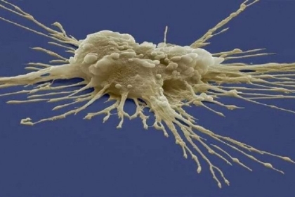 دراسة تكشف.. مرض باركنسون قد يكون مرضين في حالة واحدة!