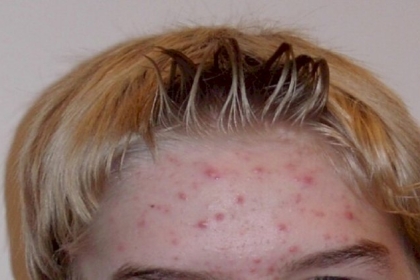 اكتشاف آلية ظهور حب الشباب