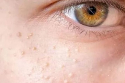 إذا رأيتها توجه للطبيب فوراً.. علامة في الجلد قد تكون تحذير من حالة صحية خطيرة