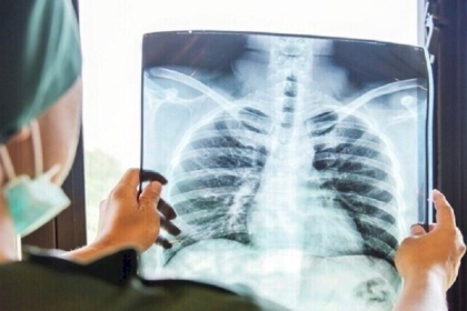 دراسة تكشف سبب عدم إصابة معظم المدخنين بسرطان الرئة