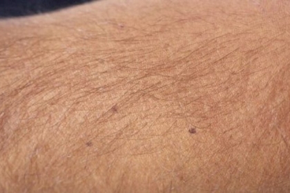 تطبيق عبر الهاتف يساعد على اكتشاف سرطان الجلد