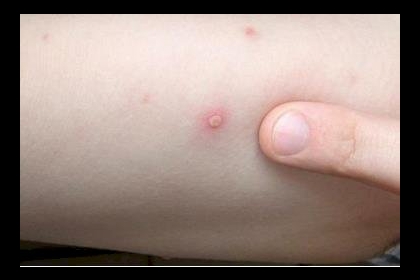 "الصحة العالمية" تطمئن: لا خوف من تحوّل جدري القرود لجائحة