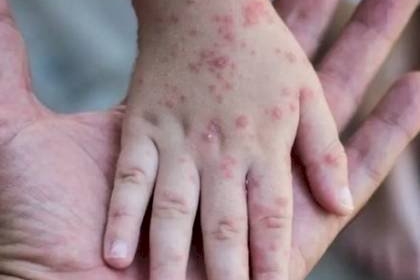 الصحة تنفي تسجيل إصابة بـ "جدري القردة"