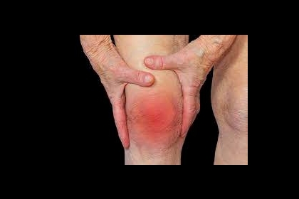 تعديل النظام الغذائي تأثيره ضئيل أو معدوم في تطور التهاب المفاصل