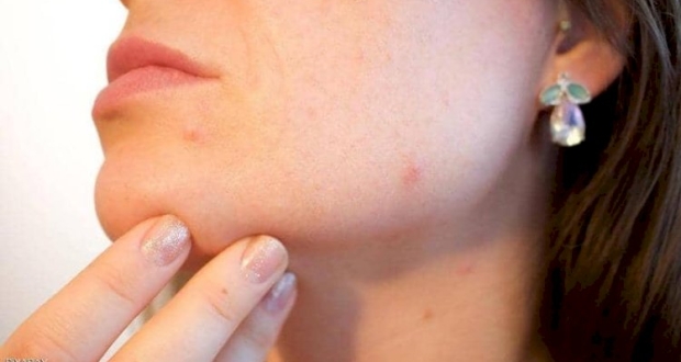 حب الشباب مشكلة تؤرق الكثير من المراهقين.